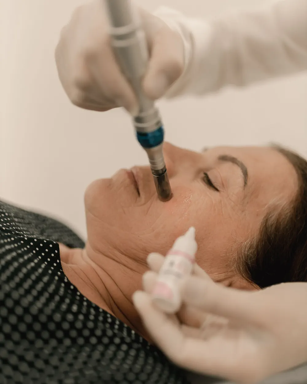 Microneedling med serum i ansiktet